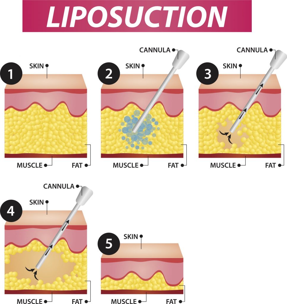 liposuction diagram